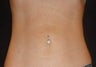 SmartLipo MPX