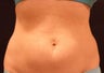 SmartLipo MPX