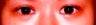 Bilateral Asian Blepharoplasty