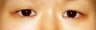 Bilateral Asian Blepharoplasty