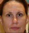 Botox