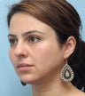 Facial Dermafillers