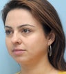 Facial Dermafillers