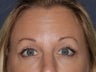 Before & After Botox