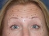 Before & After Botox