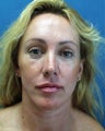 face/neck lift