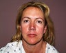 face/neck lift