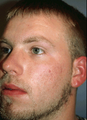 Acne Treatment