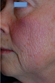 Fractional C02 Laser