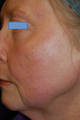 Fractional C02 Laser