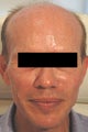 Sculptra Injections Los Angeles Before and After Photos