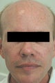 Sculptra Injections Los Angeles Before and After Photos