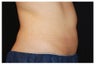 CoolSculpting