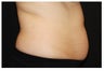CoolSculpting