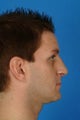 33 year old male who wanted to improve his breathing, less of a hump and droopy tip, but he wanted to have masculine nose.
