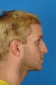 33 year old male who wanted to improve his breathing, less of a hump and droopy tip, but he wanted to have masculine nose.
