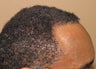 FUE hair transplantation in an African American male