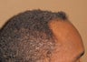 FUE hair transplantation in an African American male