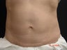 Coolsculpting Abdomen