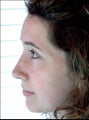 Projecting nose with a hump