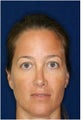 Non Surgical Rhinoplasty