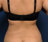 Liposuction