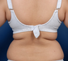 Liposuction