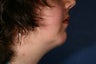 37 Year Old Chin Augmentation