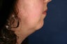 37 Year Old Chin Augmentation