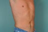 Smart Lipo