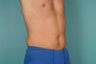 Smart Lipo