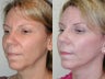 Minimally Invasive Facelift