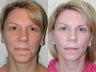 Minimally Invasive Facelift