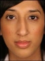 Female Primary Rhinoplasty