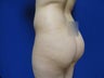 24 year old Fat grafting to butt and hips - second view