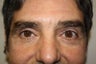 Functional Blepharoplasty