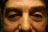Functional Blepharoplasty