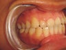Edge to edge bite, when it damages your teeth and makes you look older