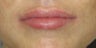 Mild to moderate volume loss in upper lips