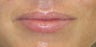 Mild to moderate volume loss in upper lips