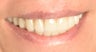 Full Mouth Reconstruction with Porcelain Crowns and Veneers