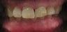 Full Mouth Reconstruction with Porcelain Crowns and Veneers