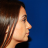 Rhinoplasty