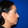Rhinoplasty