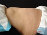 Coolsculpting Lower Abdomen