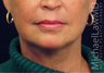 Lower Face Lift