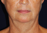 Lower Face Lift