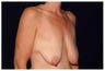 Breast Lift