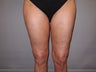49 Year Old Female treated for Cellulite Reduction - Cellulaze