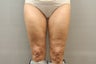 49 Year Old Female treated for Cellulite Reduction - Cellulaze